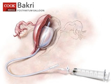 bakri postpartum balloon with rapid installation components 1 ea bakri balloon