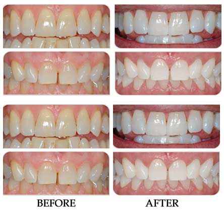 best teeth whitening gel