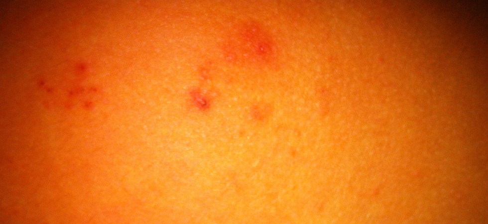 Treatment to Cure Molluscum Contagiosum for Adults and Children using Treatment to Cure Molluscum Contagiosum for Adults and Children using