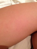 Cured by Molluscum contagiosum home remedy treatment. Molluscum contagiosum treatment cure. Remedies for molluscum contagiosum.
