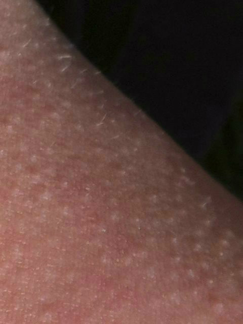 The pearly white heads of a cluster of beginning stage molluscum bumps. The pearly white heads of a cluster of beginning stage molluscum contagiosum. This cluster was approximately 5 cm (2 inches) square and consisted of over 200 individual bumps.