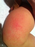 Molluscum on the thigh of a 14 month old baby before remedy for molluscum contagiosum applied. Molluscum on the thigh of a 14 month old baby before remedy for molluscum contagiosum applied.