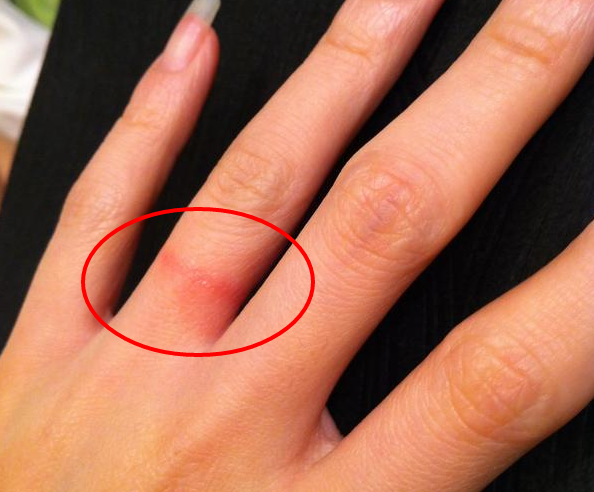 Черные полосы от золотого кольца. Аллергия на серебро кольца. Раздражение на пальце от кольца.
