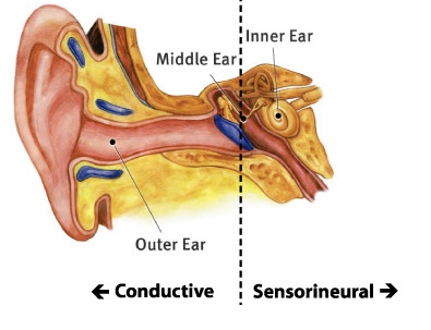 Types of Hearing Loss Types of Hearing Loss