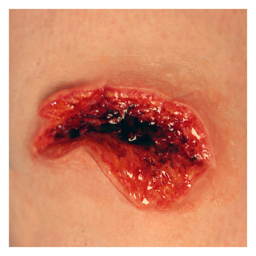 Large Avulsion Mold