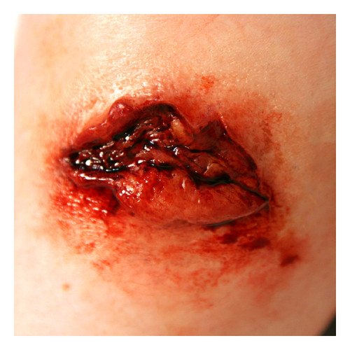 Medium Avulsion Mold