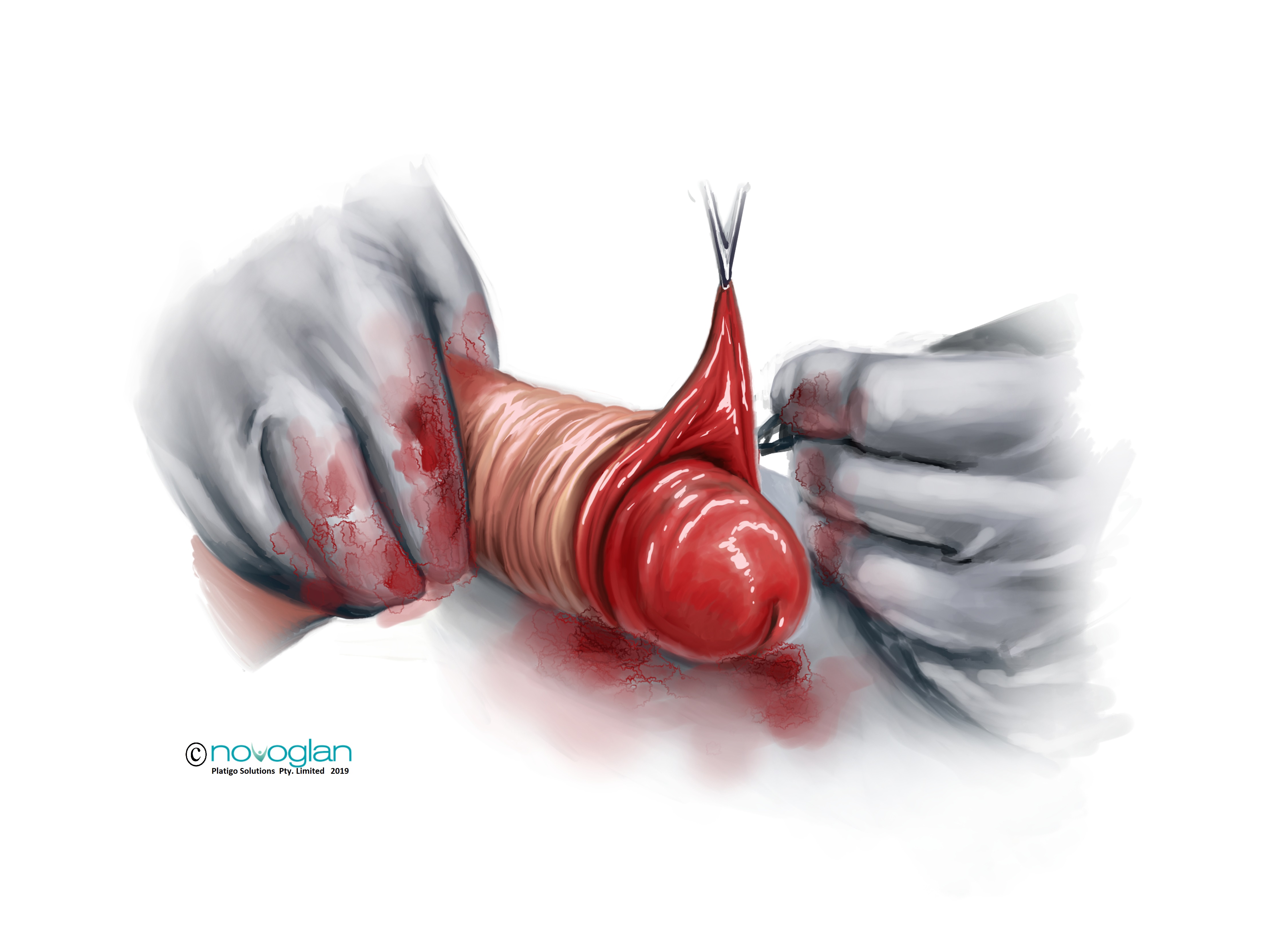 Circumcision-prevention-with-novoglan