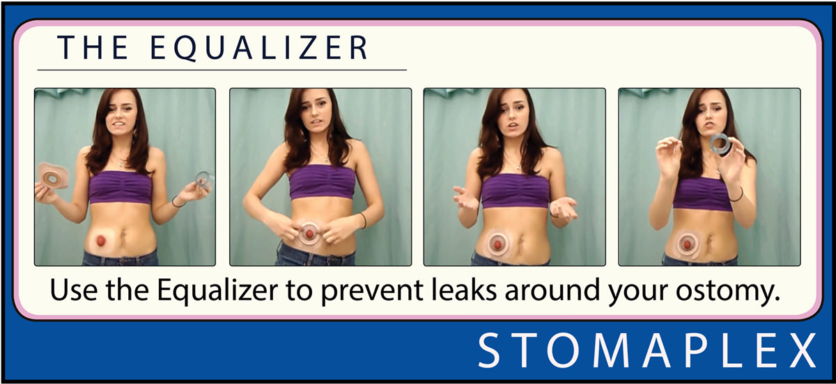 Stomaplex Ostomy belts and Stomaplex Stoma Guards for patients with an ostomy who are looking to stay active and be confident with their lives.
The stomaplex ostomy belt and stoma guard protects the stoma while maintaing a low profile.
If you are looking for ostomy clothing, consider the stomaplex ostomy belt and stoma guard.
The Stomaplex Equalizer is a great tool to extend the life of your ostomy wafer by applying pressure on the ostomy skin barrier The active lifestyle in you will appreciate the Stomaplex ostomy belt and stomaplex stoma guard that is designed for the ostomate with an active life.