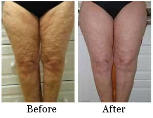 ultrasonic-lipo-cavitation-before-after