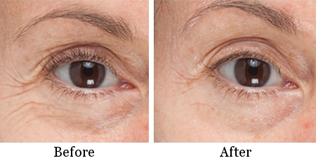 roseacea-laser-treatment-before-and-after