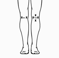 Proper placement of tens unit pads for knee pain.