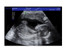Fake Pregnancy Fake Sonogram with Blue Bars
