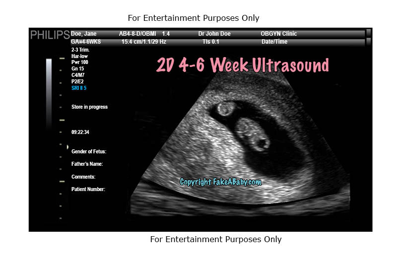 dating twin pregnancy by ultrasound iggy azalea dating asap rocky