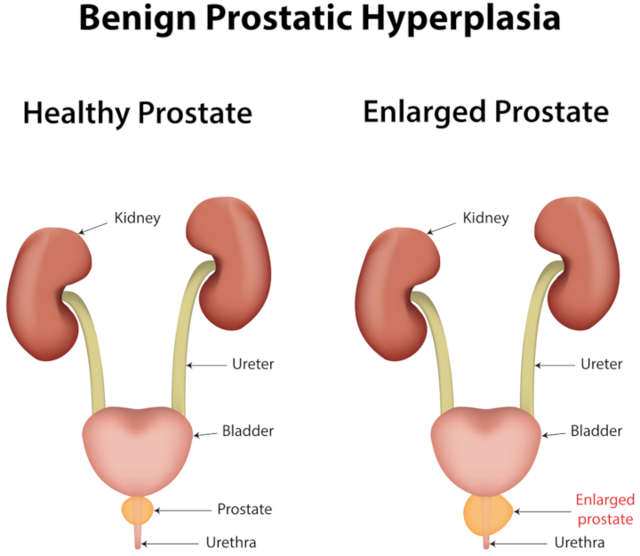 15-prostate01.jpg 15-prostate01.jpg