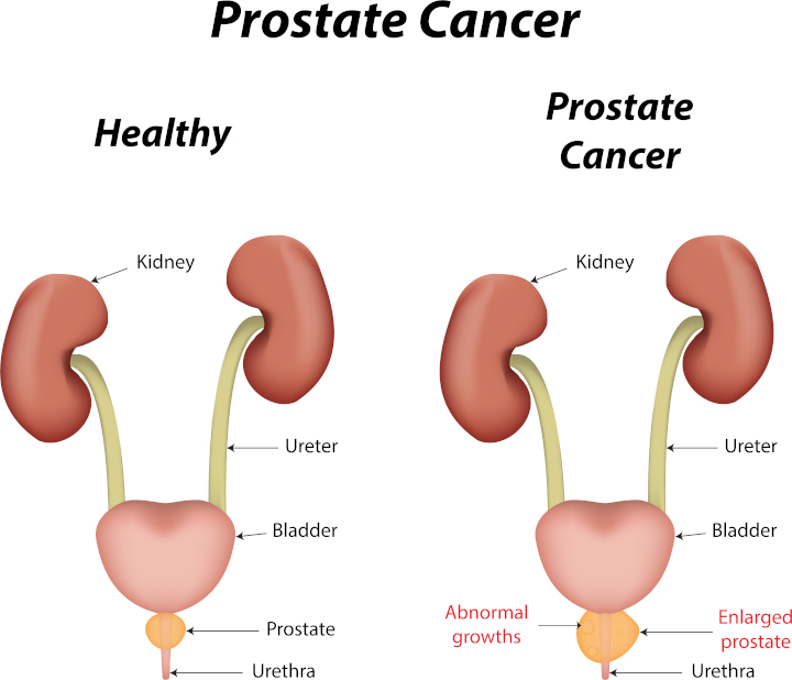 15-prostate02.jpg 15-prostate02.jpg
