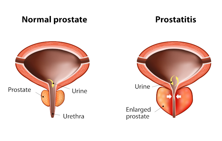 15-prostate03.jpg 15-prostate03.jpg