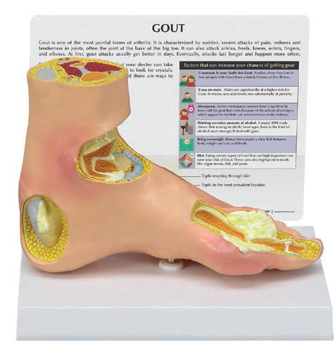 Gout Foot Model - Clinical Charts and Supplies
