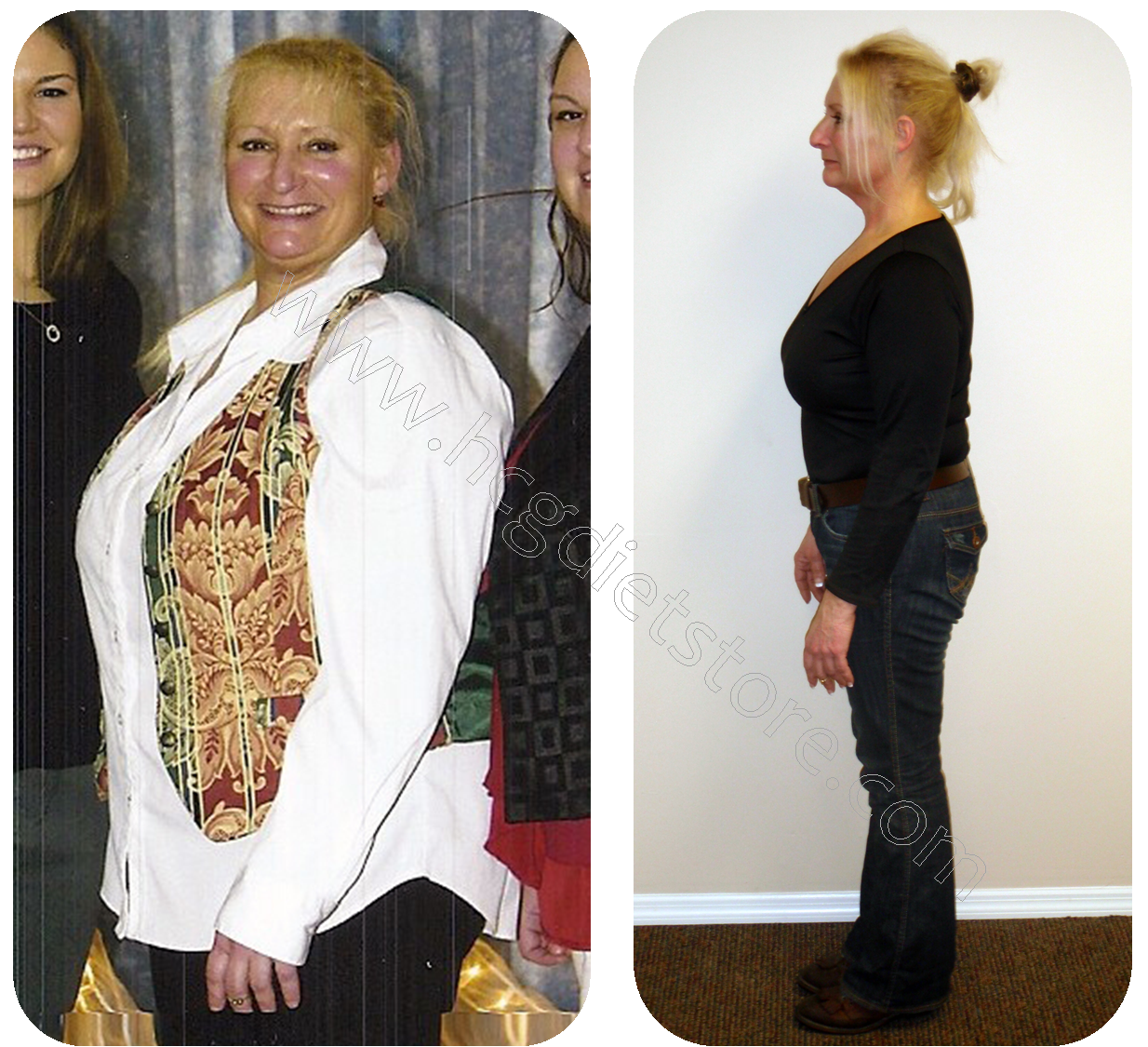 hcg diet before and after, hcg before and after, hcg weight loss before and after, before and after pictures for HCG