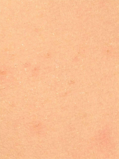 Two treatments is all it took to kill off this molluscum virus skin infection. Dead molluscum bumps after only two treatments.