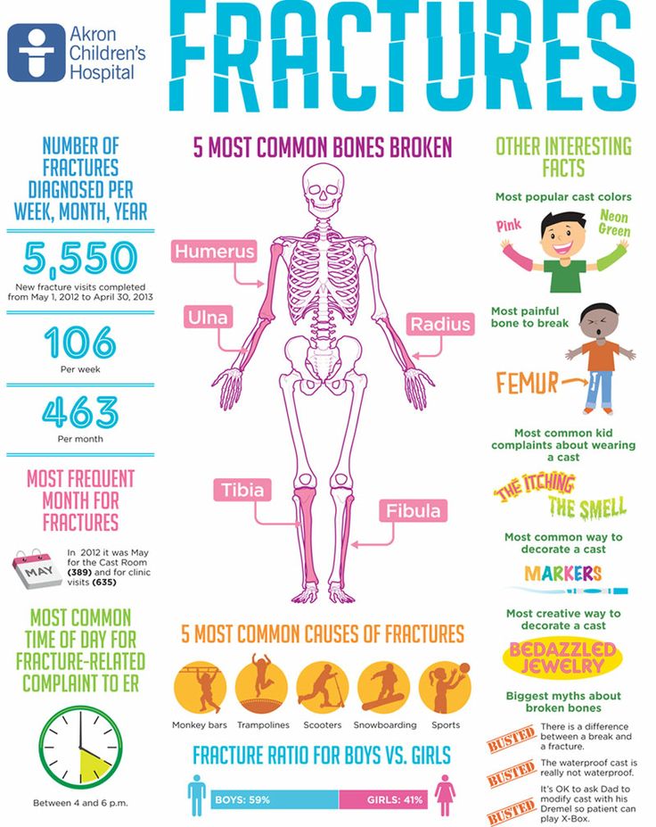Interesting Facts About Fractures CastCoverz!