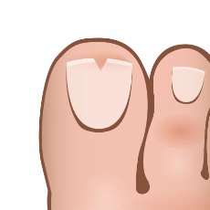 How to Get Rid of an Ingrown Toenail | CurveCorrect
