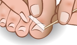 in-grown-toenail-brace-5