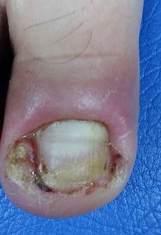 Toenail Infection