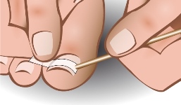 ingrown-toenail-brace-1