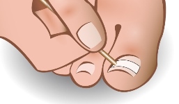 ingrown-toenail-brace-6