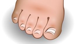 ingrown-toenail-brace-9