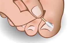 ingrown-toenail-braces-3
