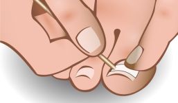 ingrown-toenail-braces-8