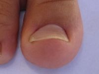 ingrown-toenail-home-treatment-after