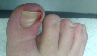Ingrown Toenail Surgery Curvecorrect Ingrown Toenail Surgery Stage2 Jpg