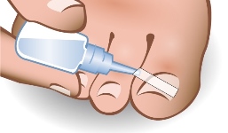 toenail-brace-7