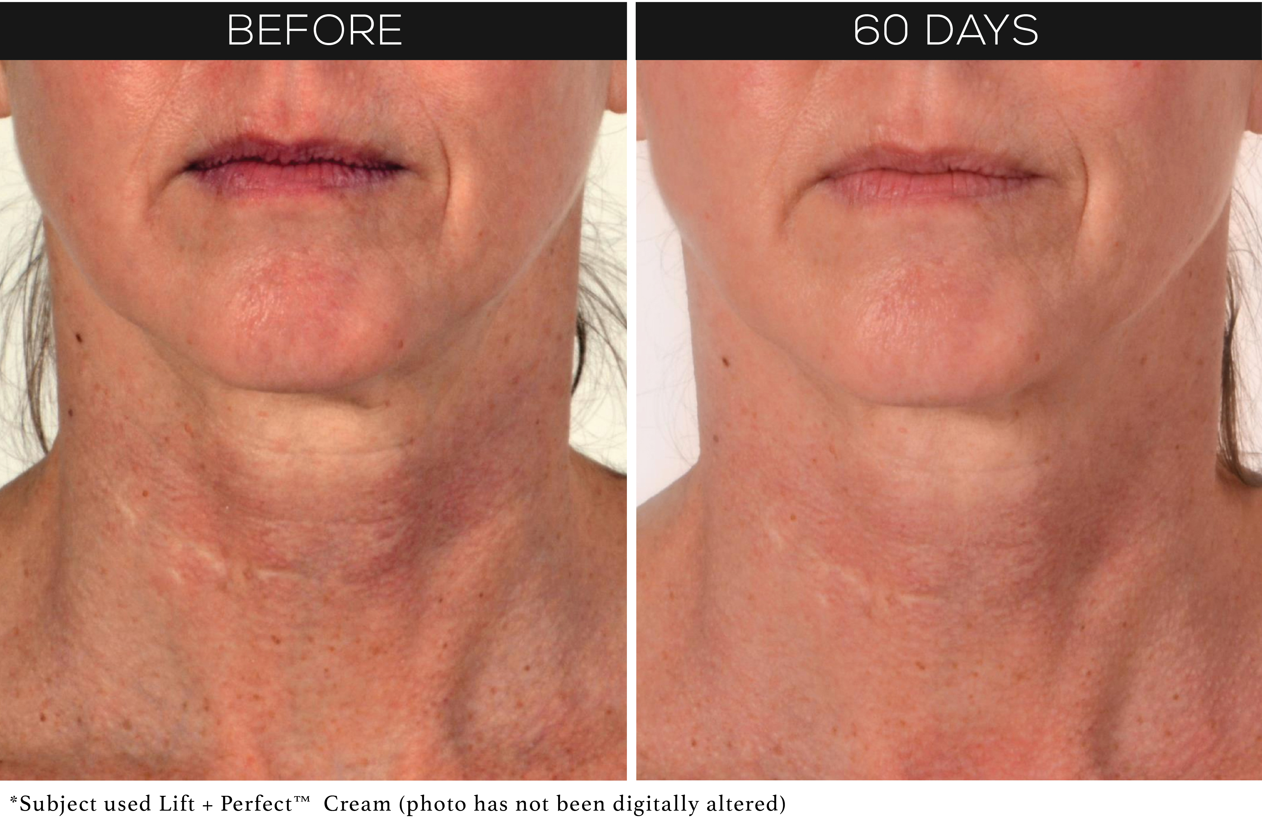 before-after-lift-perfect-neck2.jpg