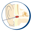 suction-vacutract-zoom-in-ear.jpg